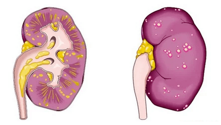 Akut prostatit nedir